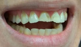 לפני:Laminate Veneer בשיניים קדמיות