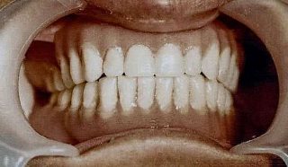 תותבות זמניות, עקירות, תותבות קבועות