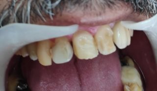 לפני:השחזה, טיפול זמני, הדבקה, Laminate Veneer