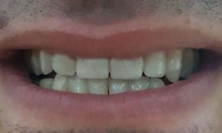 מבנה קומפוזית, ערוכת כותרת, כתרים זמניים, כתרים Emax