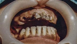 לפני:תותבת מיידית עם שיניים לתותבת קבוע