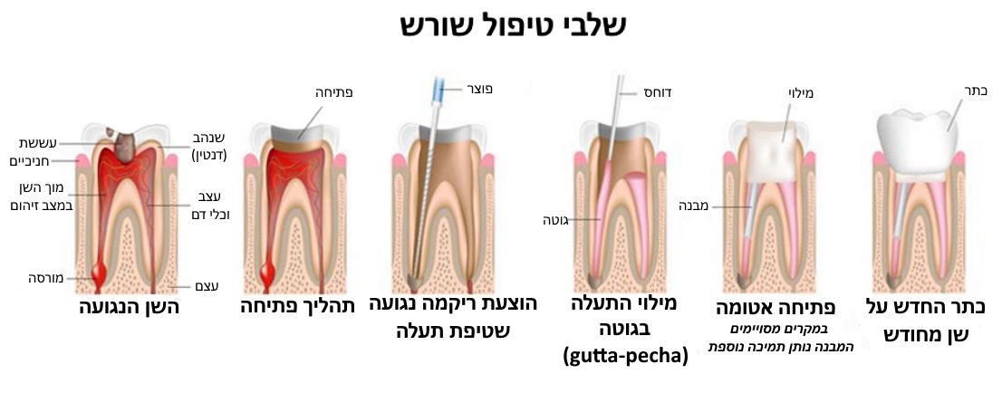שלבי טיפול שורש
